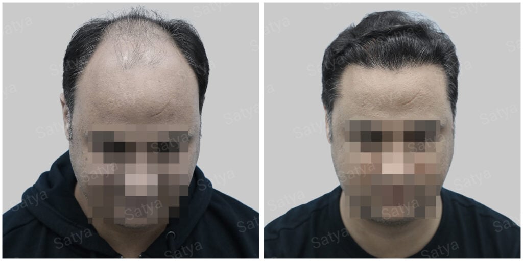 Case abhinav sondhi 10 synthetic hair implant