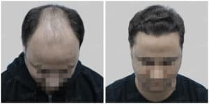 synthetic hair implant