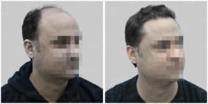 synthetic hair implant