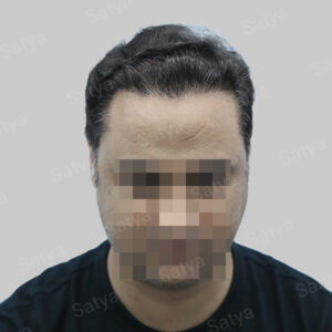 synthetic hair implant