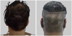 synthetic hair implant in delhi