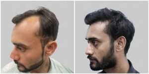 synthetic hair transplant