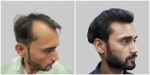 synthetic hair transplant