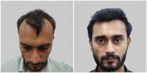 synthetic hair transplant