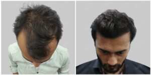 synthetic hair transplant