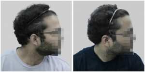 synthetic hair implant in delhi