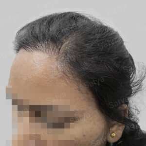 repair hair transplant