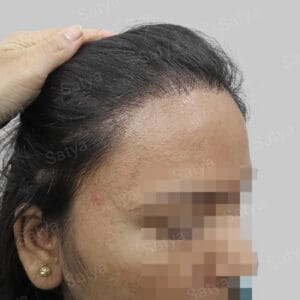 repair hair transplant