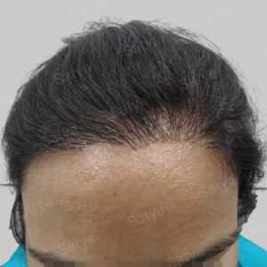repair hair transplant