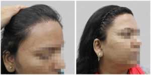 repair hair transplant
