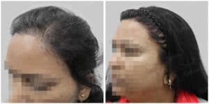 repair hair transplant