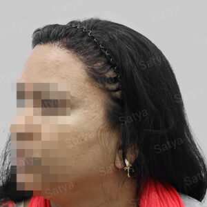 repair hair transplant