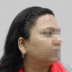 repair hair transplant