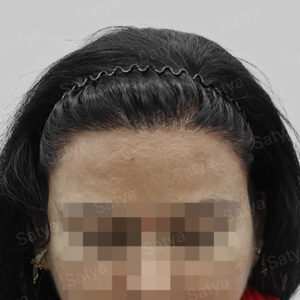 repair hair transplant