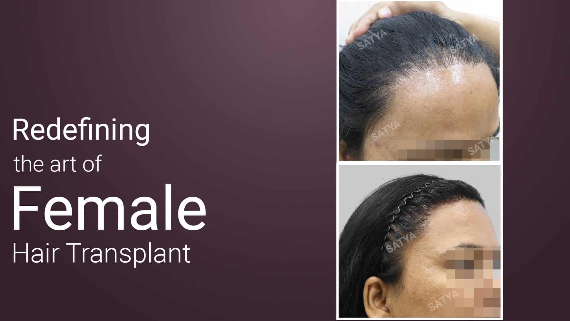 female hair transplant