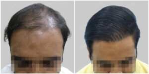 repair hair transplant