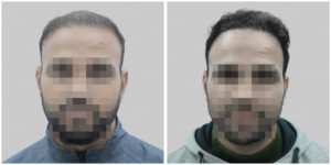 repair hair transplant result