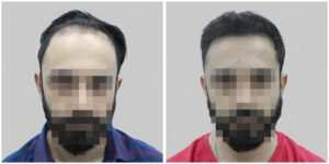repair hair transplant result India