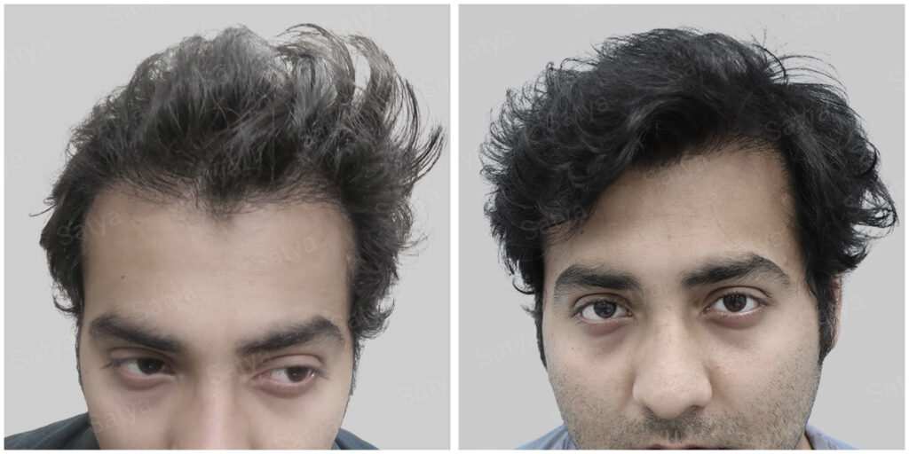 wrong hair transplant