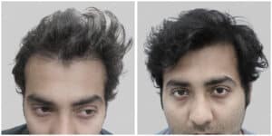 wrong hair transplant