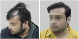 repair hair transplant