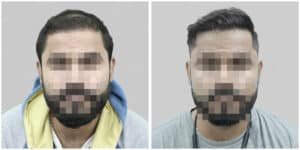 wrong hair transplant