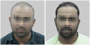 wrong hair transplant