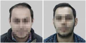 corrective hair transplant