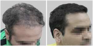 wrong hair transplant