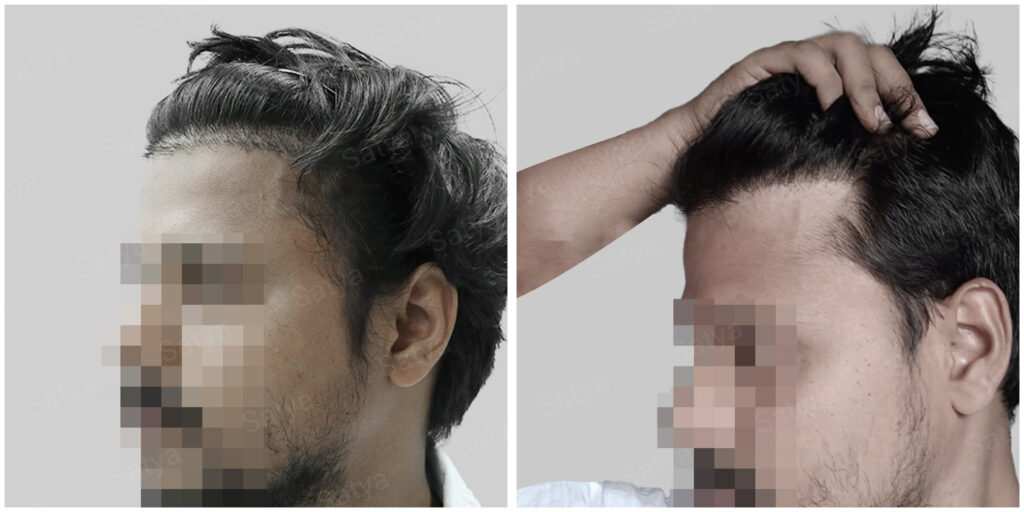 repair hair transplant