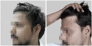 repair hair transplant
