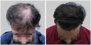 corrective hair transplant