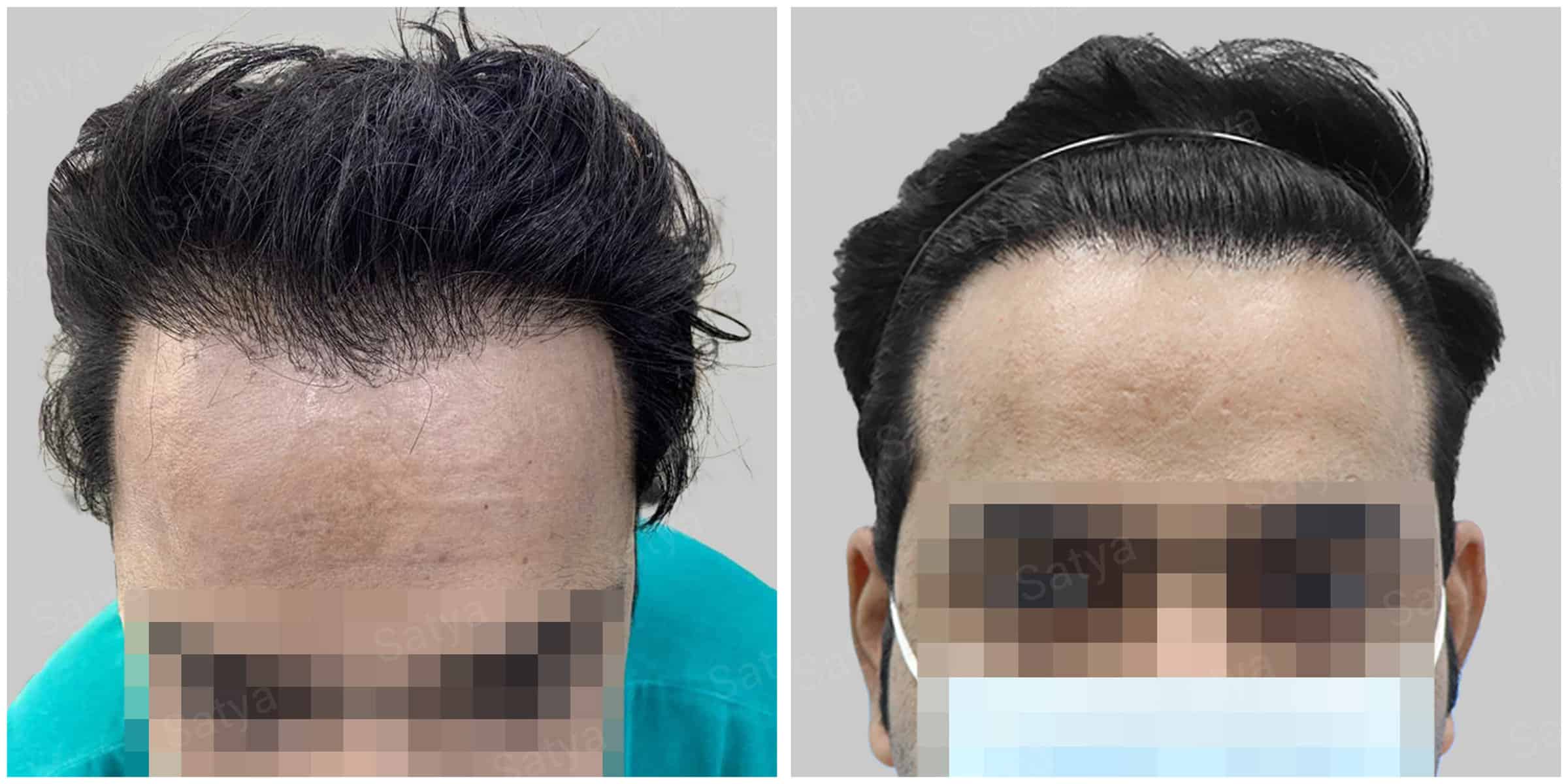 repair hair transplant result