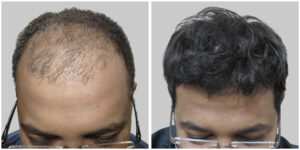fue hair transplant