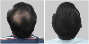 fue hair transplant