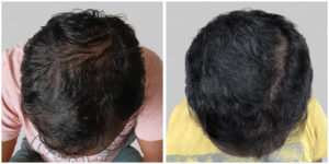 synthetic hair implant in india