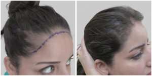 female hair transplant