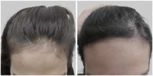 female hair transplant