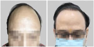 synthetic hair transplant