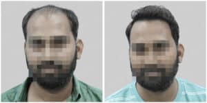 synthetic hair implant