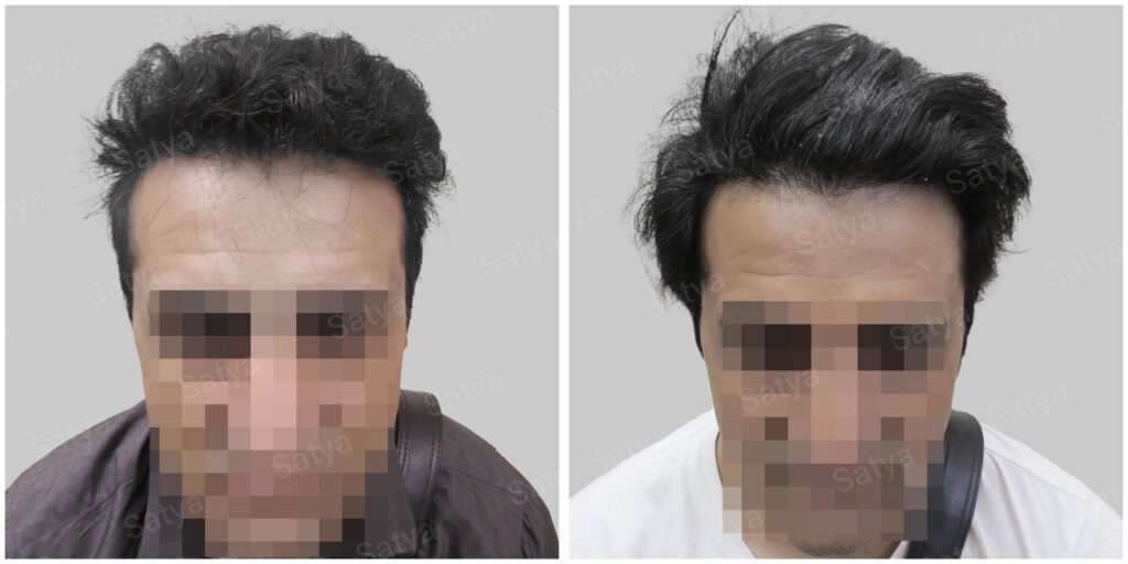 wrong hair line repair