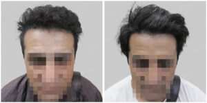 wrong hair line repair