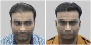 wrong hair transplant