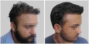 corrective hair repair result
