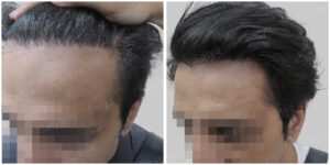 wrong hair line repair