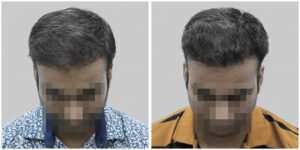 wrong hair transplant