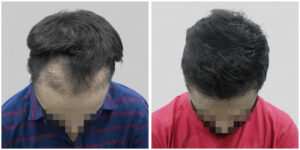 repair hair transplant result India