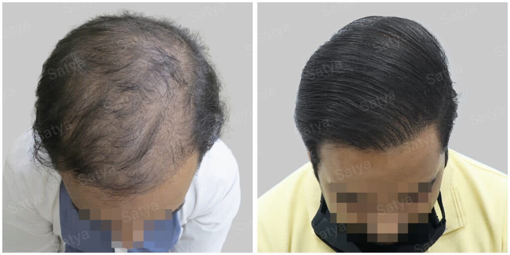 corrective hair transplant result in India