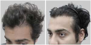 wrong hair transplant