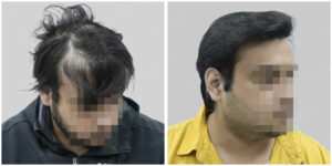 repair hair transplant